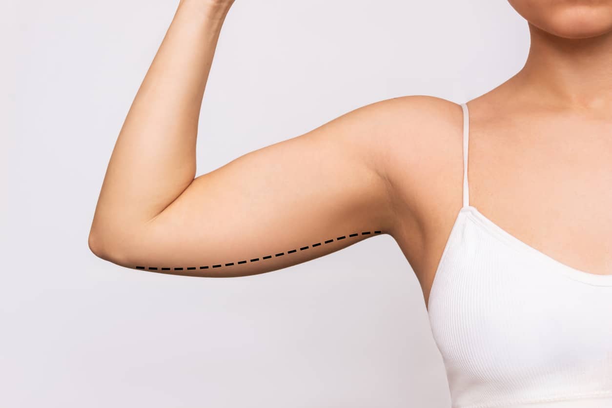 A young woman with excess fat on her upper arm with marks for liposuction or plastic surgery 1780423298 2f86acf990be46e29896b04713bcc727 1