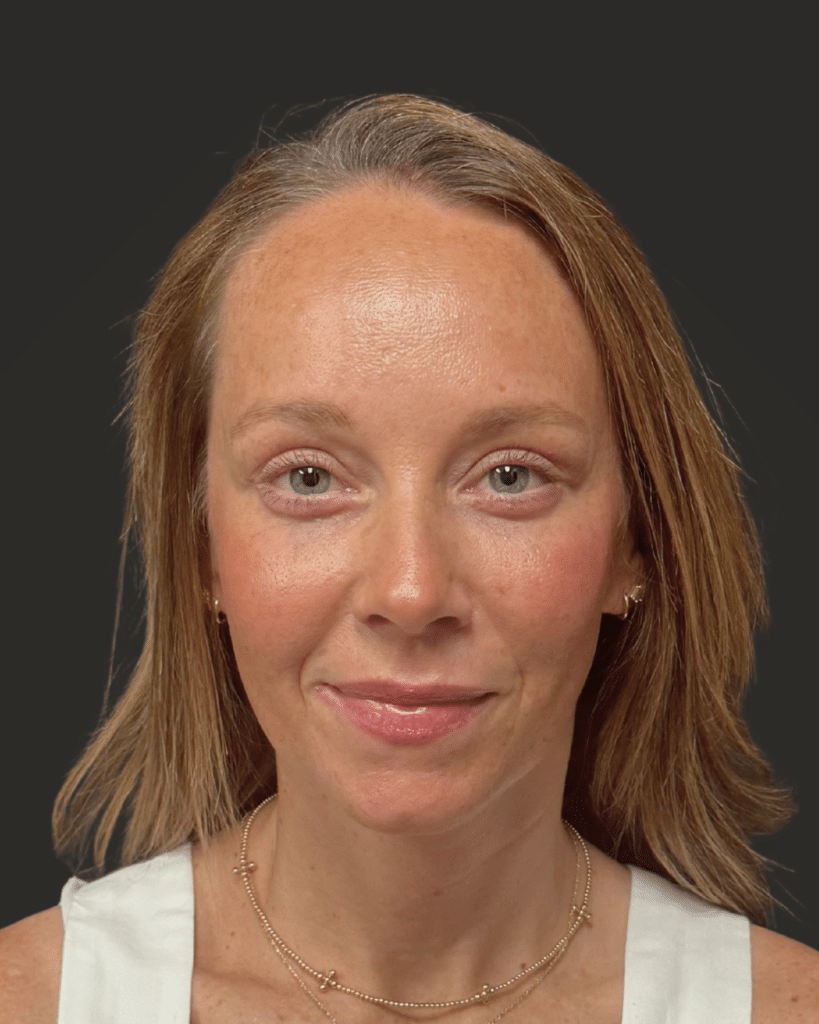 After Image: Brow Lift; Upper Blepharoplasty; Lower Blepharoplasty; Facial Fat Grafting - front