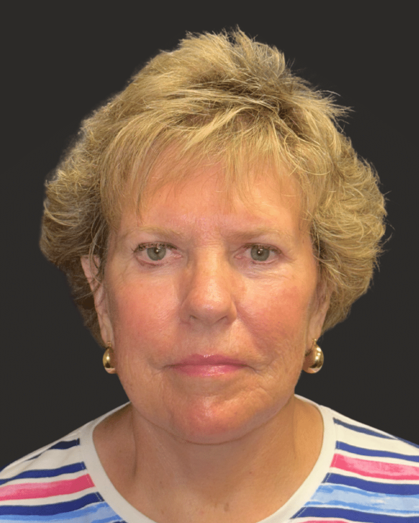 After Image: Deep Plane Facelift & Neck Lift - front