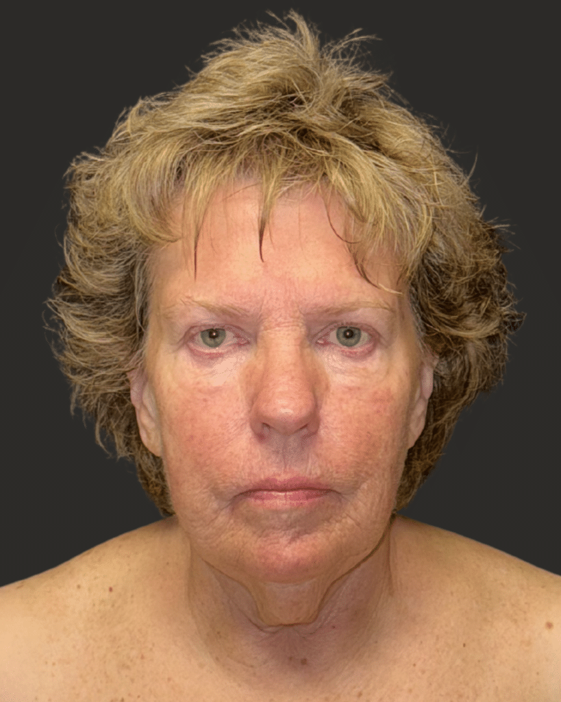 Before Image: Deep Plane Facelift & Neck Lift - front