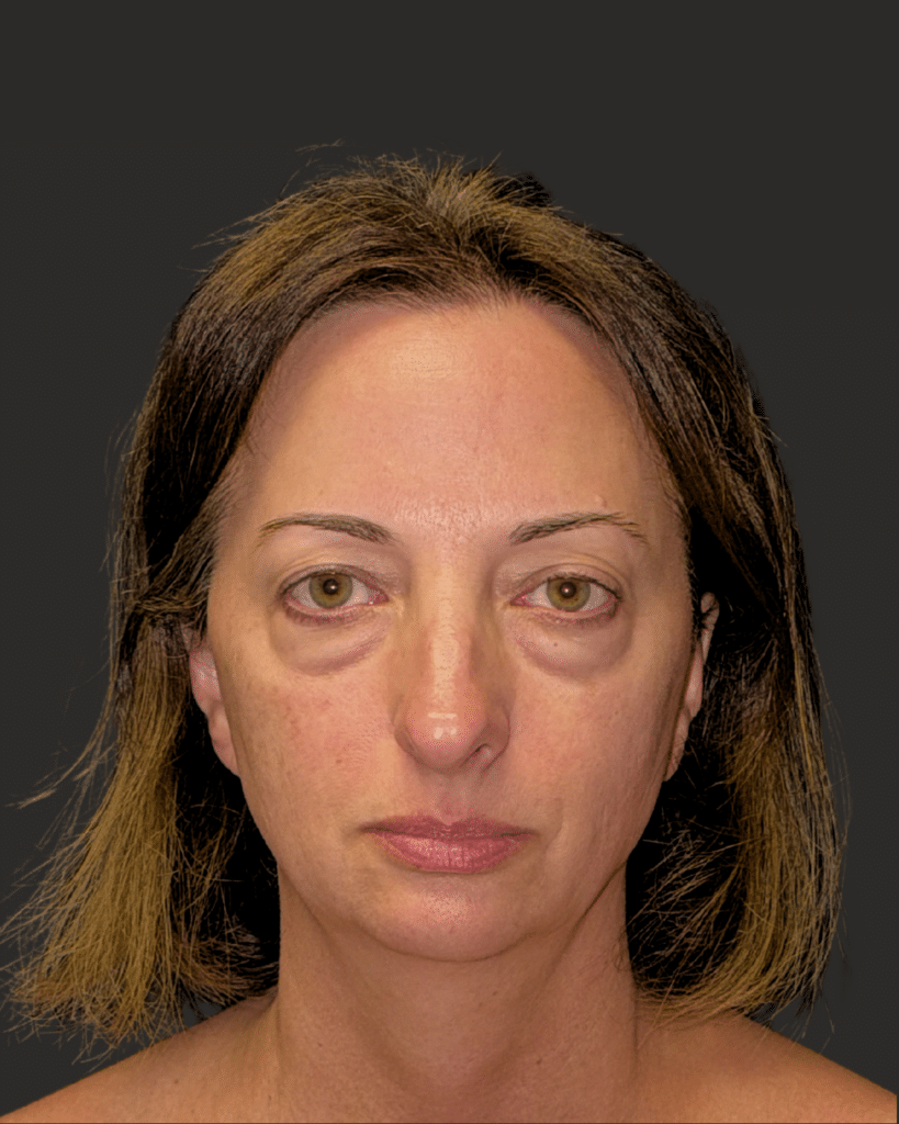 Before Image: Upper and Lower Blepharoplasty, Fat Transfer - front