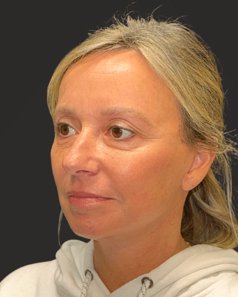 After Image: Deep Plane Facelift & Neck Lift - left-front-oblique