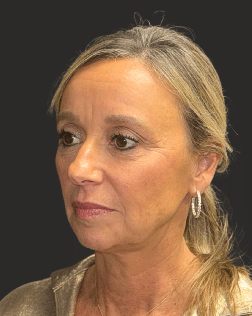 Before Image: Deep Plane Facelift & Neck Lift - left-front-oblique