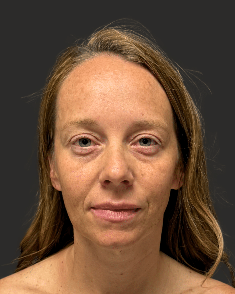 Before Image: Brow Lift; Upper Blepharoplasty; Lower Blepharoplasty; Facial Fat Grafting - front