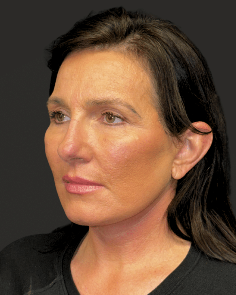 After Image: Deep Plane Facelift & Neck Lift; Upper Blepharoplasty - left-front-oblique