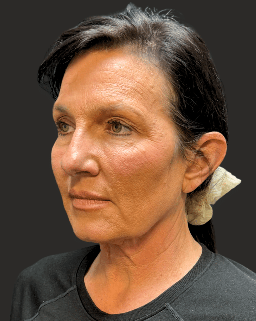 Before Image: Deep Plane Facelift & Neck Lift; Upper Blepharoplasty - left-front-oblique
