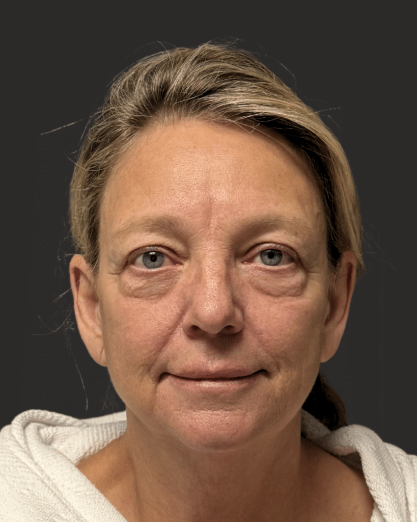 Before Image: Upper Blepharoplasty, Lower Blepharoplasty, Temporal Brow Lift, Facial Fat Grafting - front