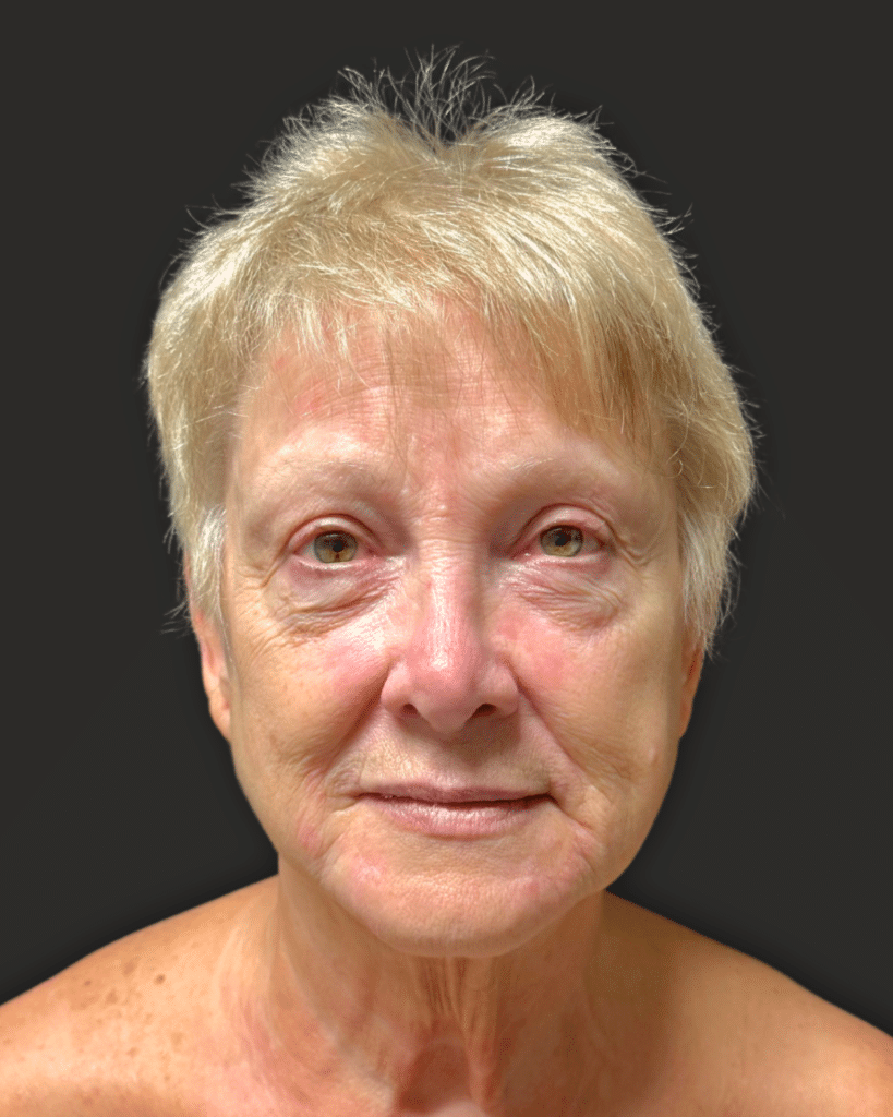 Before Image: Deep Plane Facelift & Neck Lift, Secondary Lower Blepharoplasty, Full Face Laser Resurfacing - front