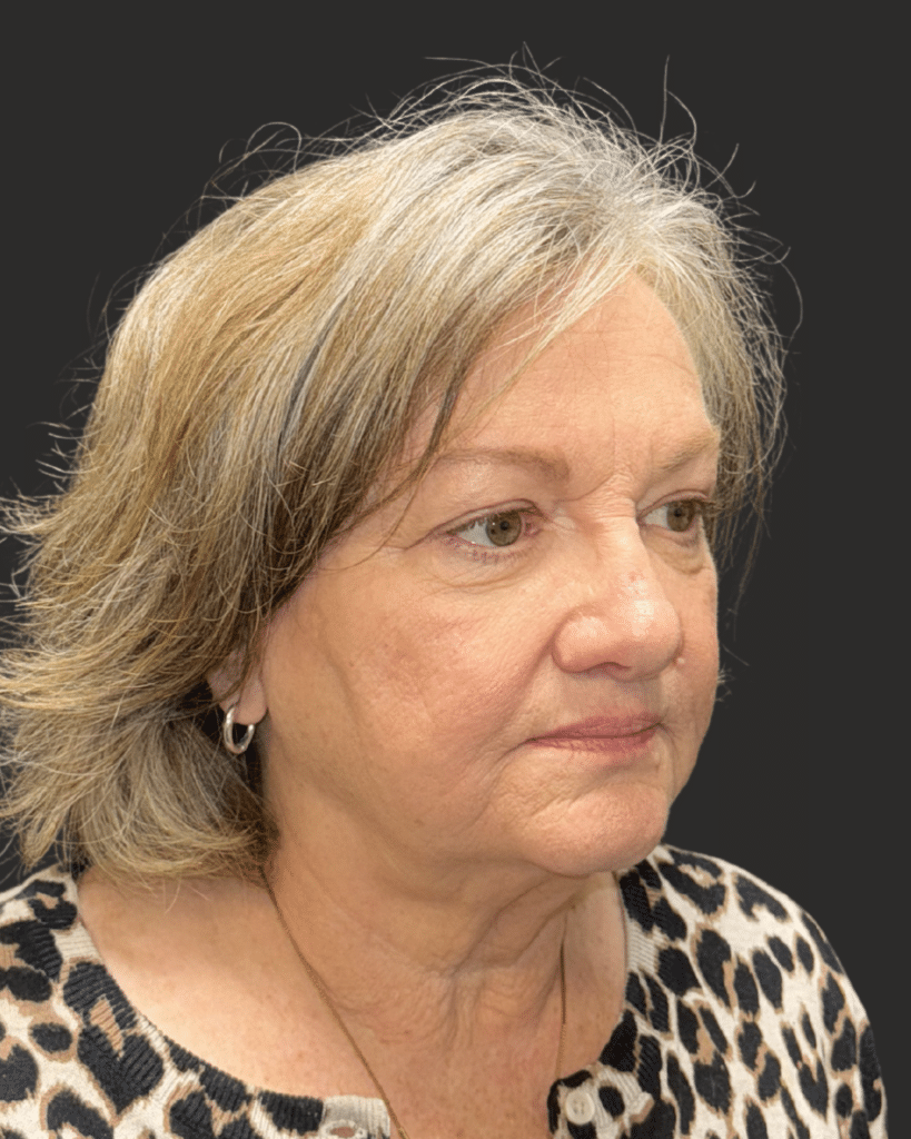 Before Image: Deep Plane Facelift & Neck Lift - right-front-oblique