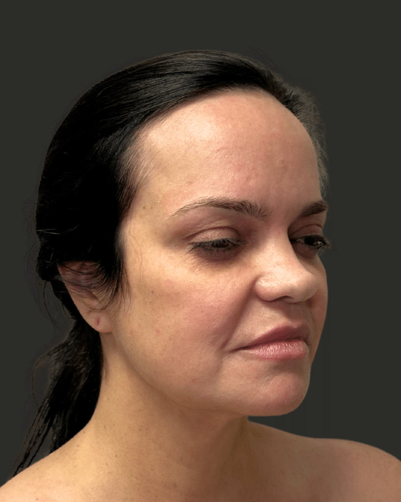 Before Image: Deep Plane Facelift & Neck Lift - right-front-oblique