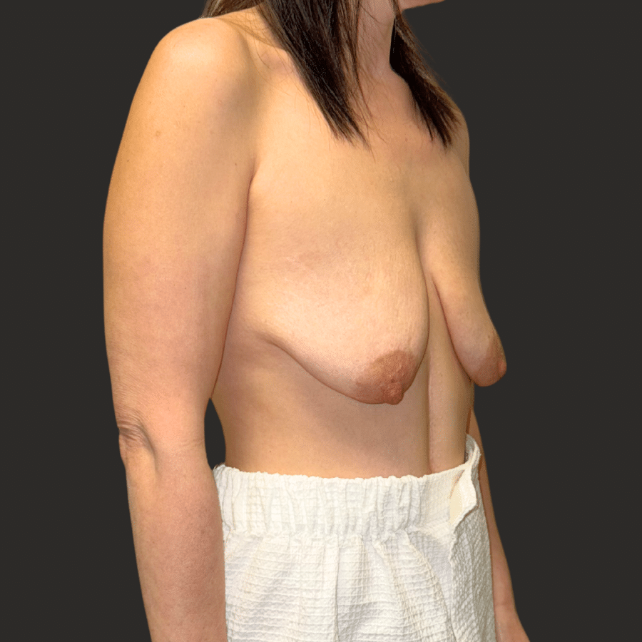 Before Image: Breast Augmentation with Mastopexy (Lift) - right-front-oblique