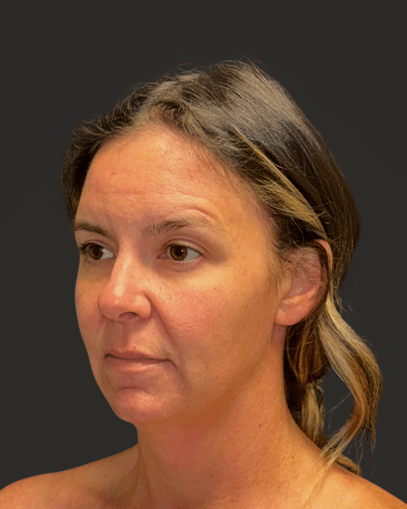 Before Image: Deep Plane Facelift & Neck Lift; Endoscopic Brow Lift - left-front-oblique