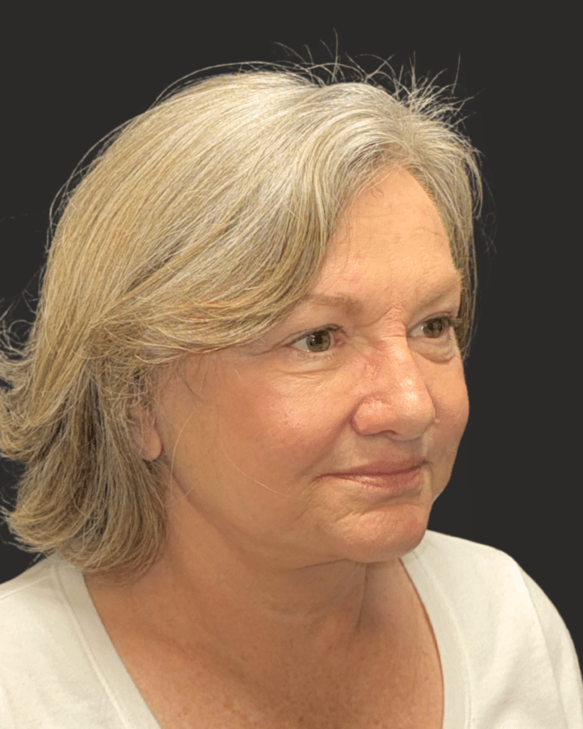 After Image: Deep Plane Facelift & Neck Lift - right-front-oblique