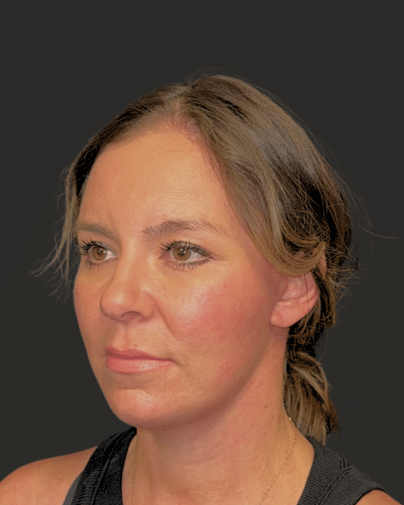 After Image: Deep Plane Facelift & Neck Lift; Endoscopic Brow Lift - left-front-oblique