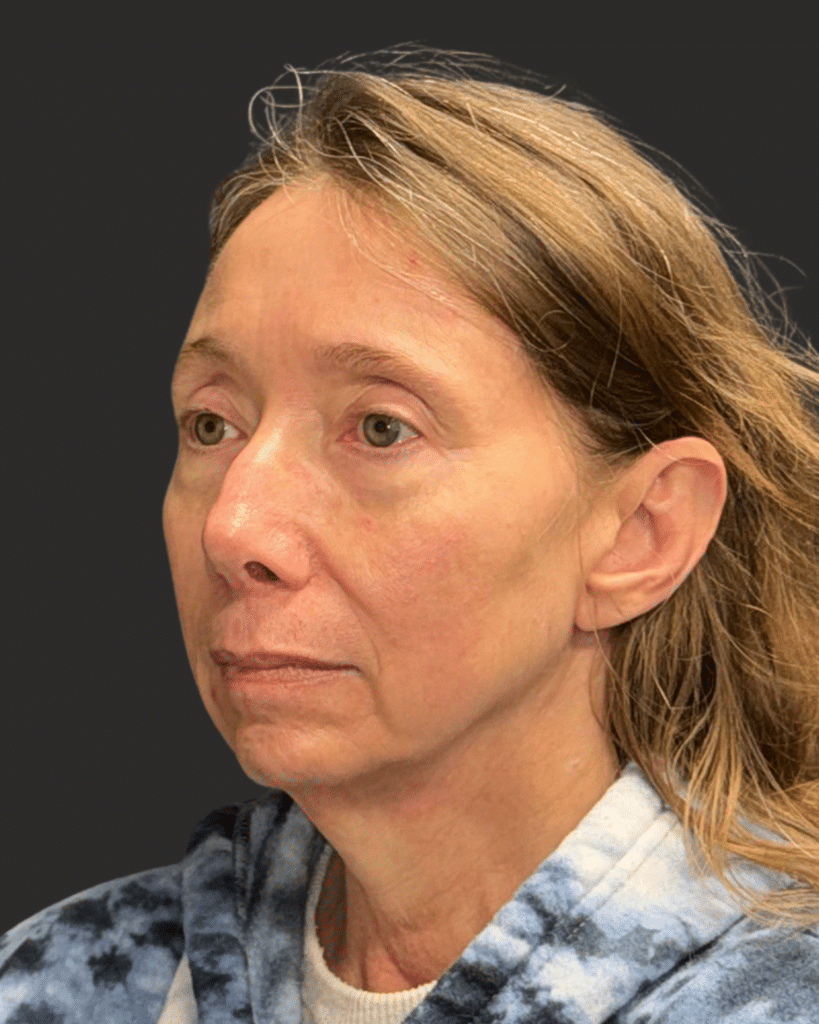 Before Image: Deep Plane Facelift & Neck Lift; Facial Fat Grafting - left-front-oblique