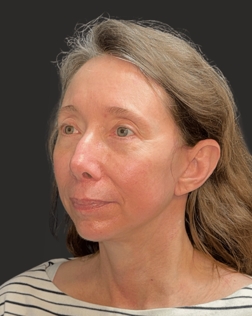 After Image: Deep Plane Facelift & Neck Lift; Facial Fat Grafting - left-front-oblique