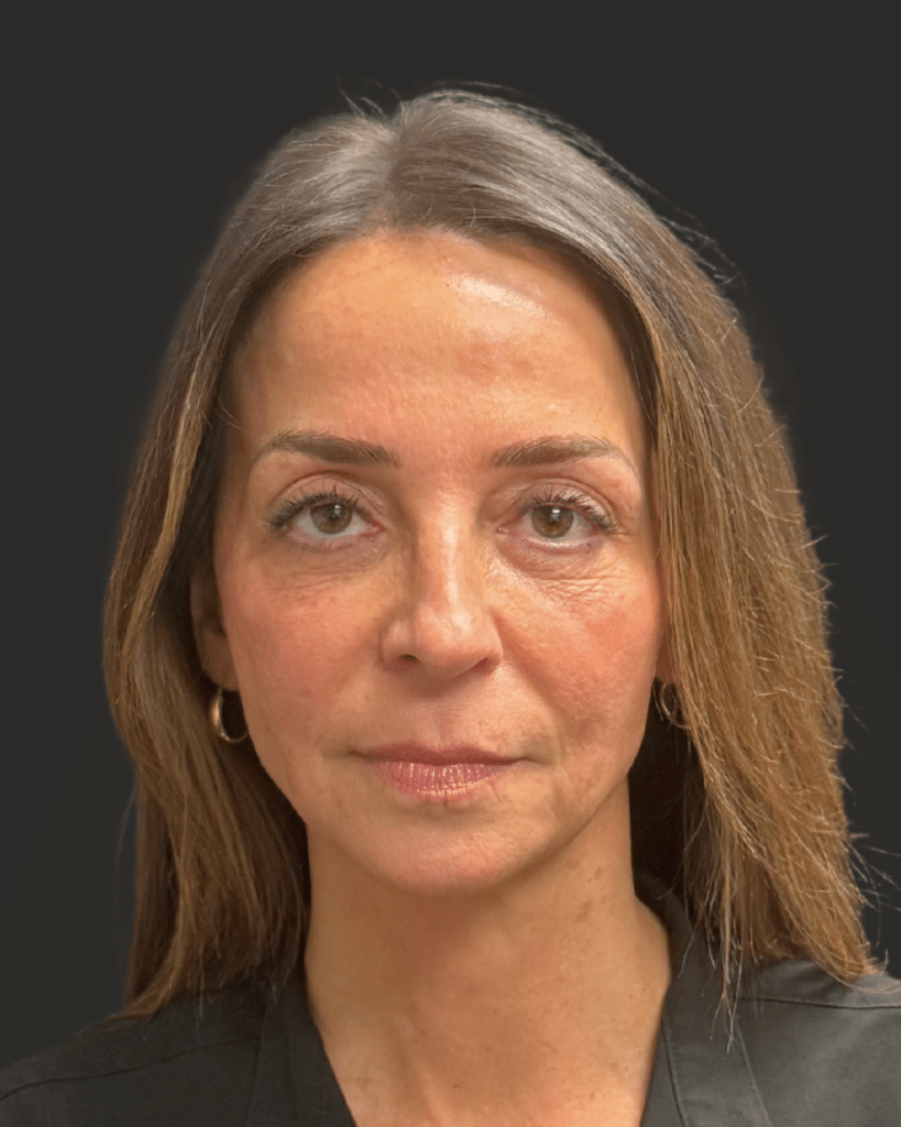 Before Image: Deep Plane Facelift & Neck Lift, Lower Eyelid Laser Resurfacing - front