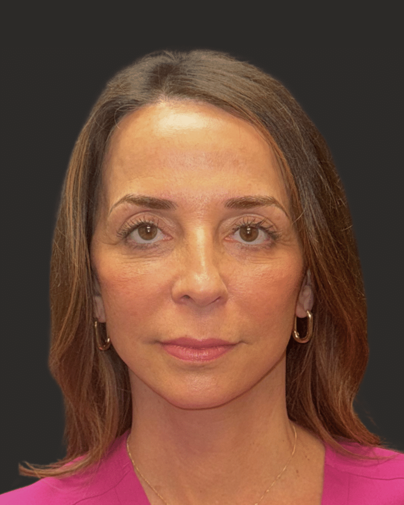 After Image: Deep Plane Facelift & Neck Lift, Lower Eyelid Laser Resurfacing - front
